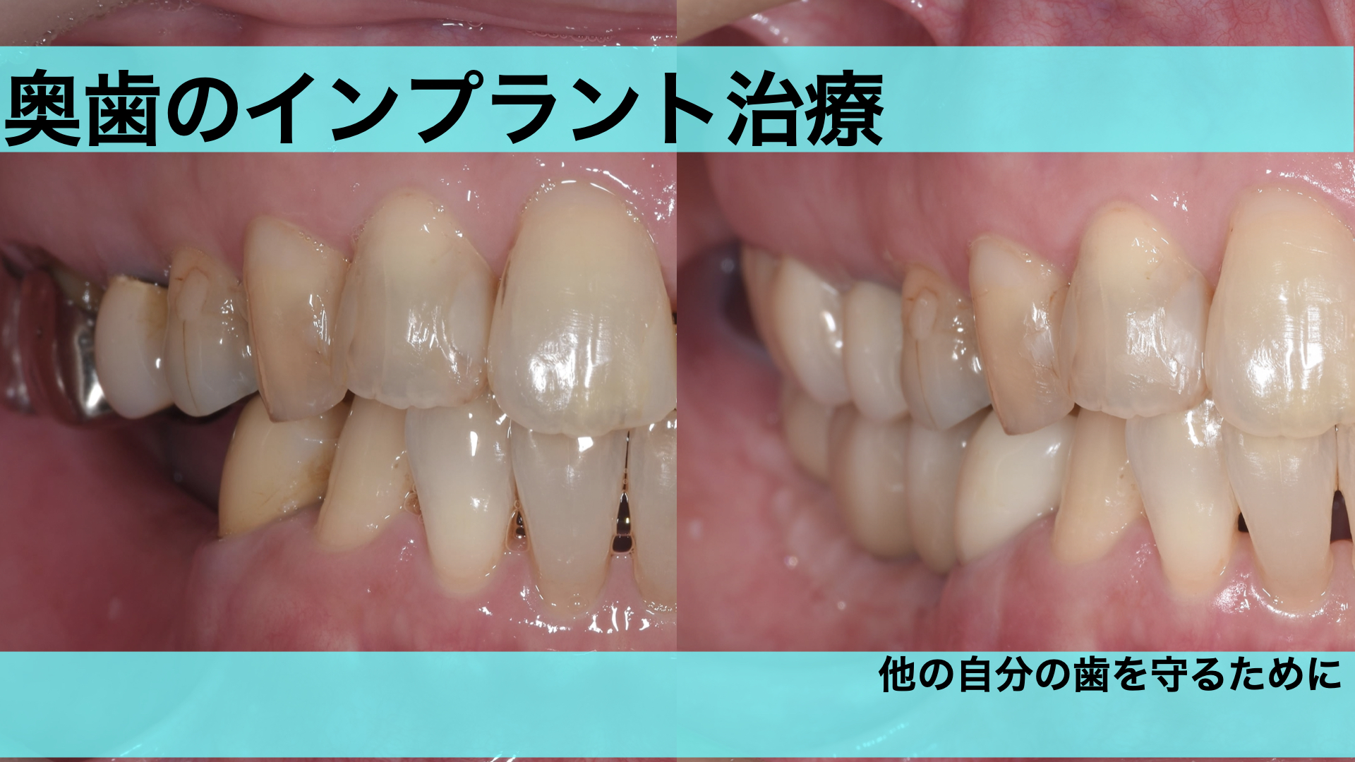 奥歯にインプラント治療を行なった症例